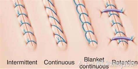 外科缝合方法有哪些,外翻缝合/内翻缝合/简单对接缝合