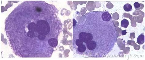  巨核细胞增多的原因,是慢性粒细胞白血病的存在