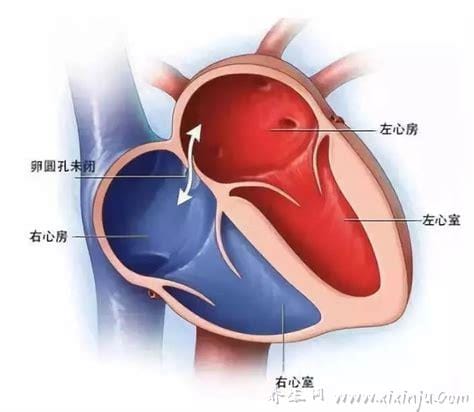 卵圆孔未闭手术费用是多少？通常在3万到5万元左右