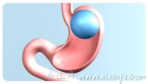 胃水球手术效果怎样,效果不错,有一定的减肥效果