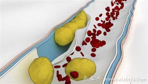 跑步一个月低密度胆固醇降低了怎么回事