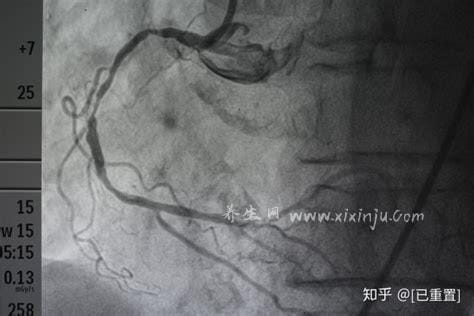 心脏造影大概多少钱？在5000元左右