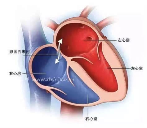 卵圆孔未闭手术费用是多少？通常在3万到5万元左右