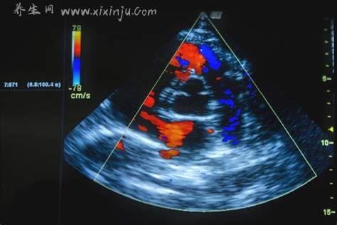 为什么不建议做心脏彩超