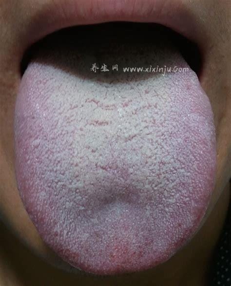 舌苔根部白腻表明肾有寒湿,不一定说明肾寒湿