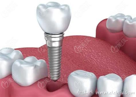 2023种植牙多少钱一颗,6000～30000元每个地区价位有所差异