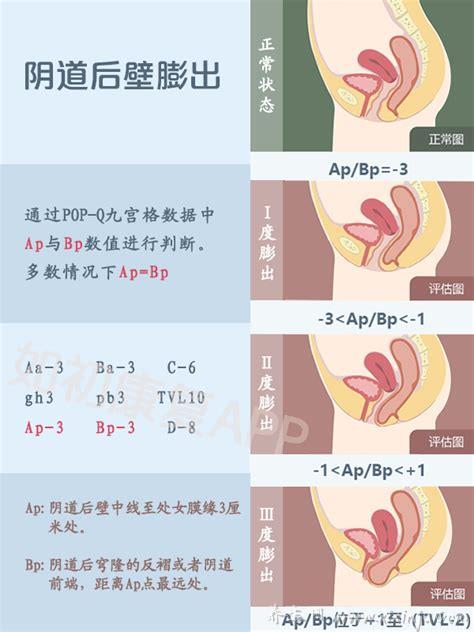 阴壁膨出1度2度3度图片,1度没有明显症状