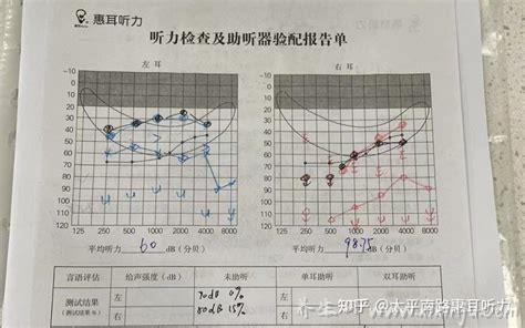 十年耳鸣一针见效,是真的（附具体治疗过程）