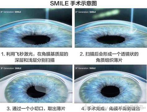 近视手术全飞秒价格表,至少6千-3万元不等（近视手术费用一览表）