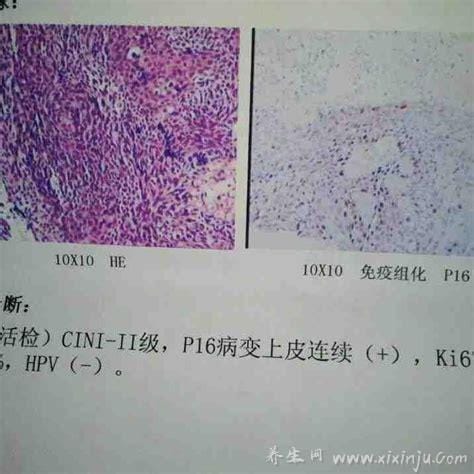 hpv自查的10个方法,可以买hpv自测试剂在家检验