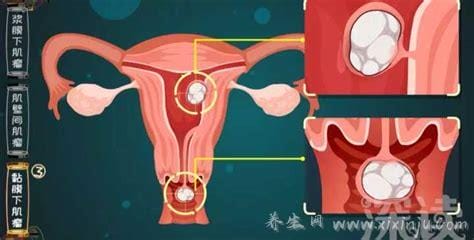 子宫肌瘤最怕三个运动,快速跑步这种高冲击运动不要做(刺激肌瘤生长)
