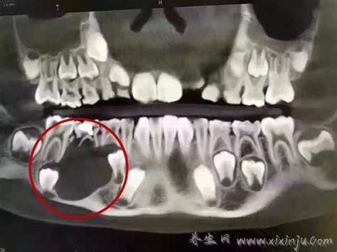 小孩换牙前的颅骨图,深度揭秘换牙过程（胆小勿看）
