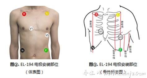 心电监护5个电极位置图及对应颜色,左腿(黑)/右腿(绿)