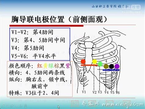 心电监护5个电极位置图及对应颜色,前胸导联(黑色)／左胸侧导联(红色)