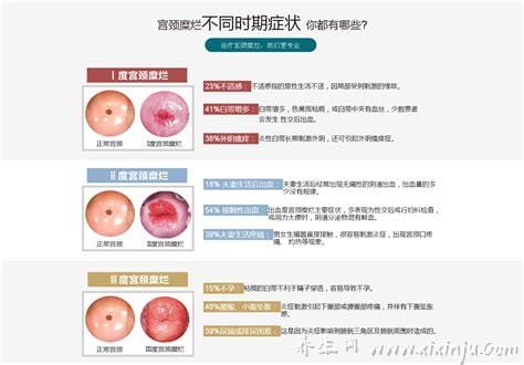 宫颈糜烂一二三度图清晰(一度宫颈糜烂／二度宫颈糜烂／三度宫颈糜烂)