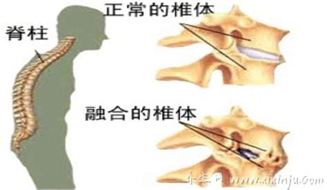 强直性脊柱炎6个地方疼,腰背痛胸痛还有神经痛