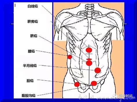 人体腹股沟在哪个位置图片,大腿里侧和腹部之间(两侧三角区域)