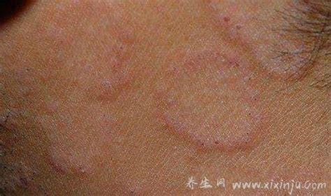 皮肤病圆癣的症状和图片,出现铜钱形状的红斑(有屑瘙痒)