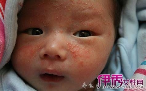 婴儿奶癣是什么样子的图片,就是湿疹有3种类型注意区分(附护理法)