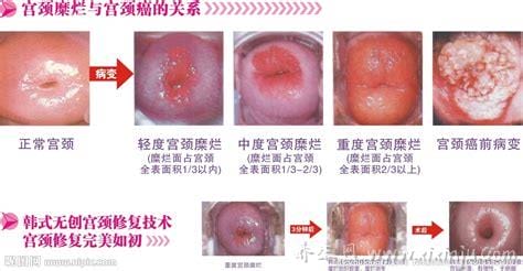 宫颈糜烂一二三度图片,白带异常可能是宫禁糜烂