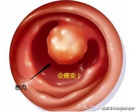 真实宫颈息肉图片早期症状,阴道少量点滴出血/白带异常(3大症状)