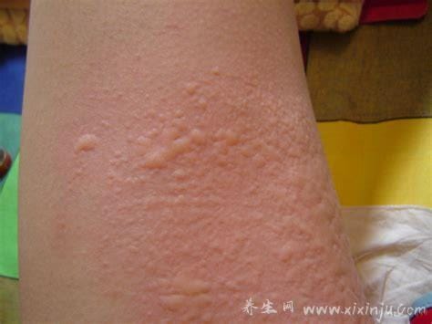 荨麻疹初期症状图片,急性有风团瘙痒还可发热(100种皮肤病对照图片)