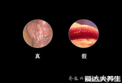 尖湿锐尤典型早期图片及症状,起初淡红色小丘疹3-5天长成菜花状疣体