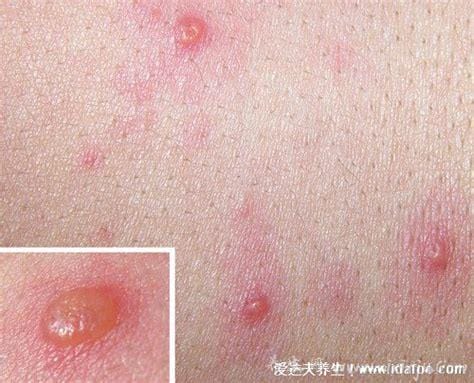 怎么判断是不是水痘图片,附7天演变过程(红色斑点类似蚊子包)