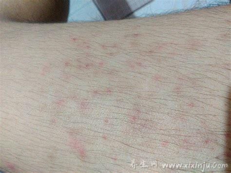 腿上起了很多红色的小点点图片,警惕湿疹/毛囊炎/银屑病等5种可能