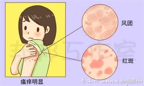 常见的荨麻疹的11个过敏源,季节更替也会引起过敏