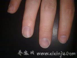 早期林赛氏指甲和正常对比图片,警惕慢性肾衰竭(多为营养不良)