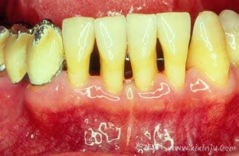 牙结石图片及症状是什么样,牙龈附近有黄色或褐色物质造成口臭