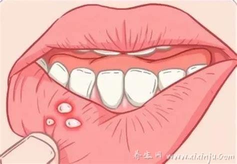 口腔溃疡偏方一次就好,4个治疗口腔溃疡的偏门土方法(亲测有效)