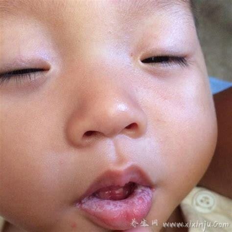 婴儿鹅口疮的图片早期症状,长在口腔的白色斑片不易刮掉(和奶苔不同)