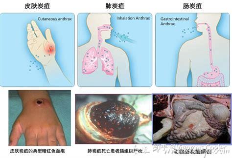 人感染皮肤炭疽病有多可怕,肺炭疽从发病到死亡只有两天(图片)