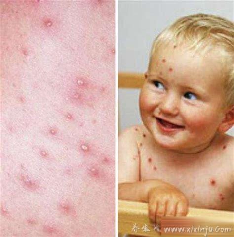 成人水痘的症状和图片初期,大人症状比儿童严重(7天演变过程图片)