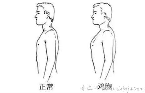 鸡胸和正常人区别图片,这一张图教你分清