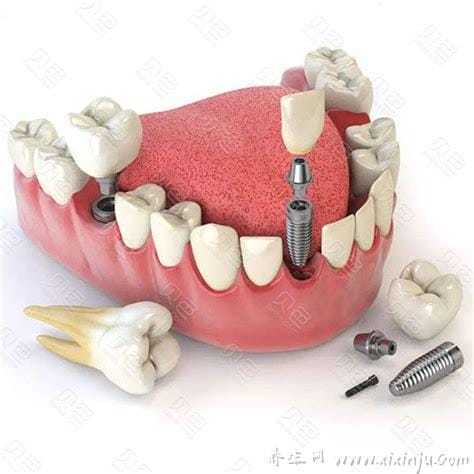种植牙齿多少钱一个2022,最低起码800元颗（种植牙齿价格）