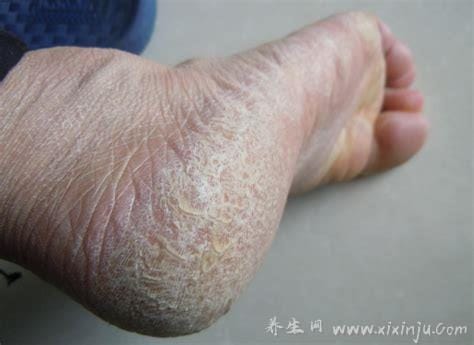 各种脚气的症状图片大全,水疱型最痒传染性最强(附根治法)