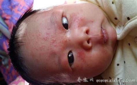婴儿奶癣是什么样子的图片,就是湿疹有3种类型注意区分(附护理法)
