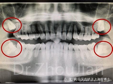 不需要拔的智齿图片,长相端正还可以增加咬合力