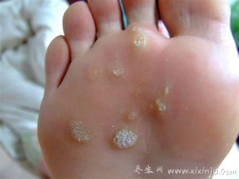 趾疣症状图片是什么样子,初期细小发亮丘疹(到后面有粗糙角质)