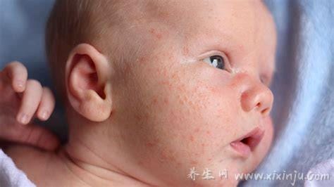儿童猩红热皮疹图片,发热全身长鸡皮样的鲜红疹要注意(7天左右消退)