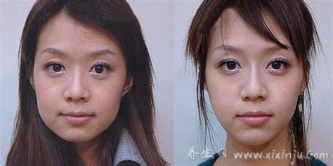 打完瘦脸针的图片效果对比,三个月脸型变化明显（附瘦脸针自测法）
