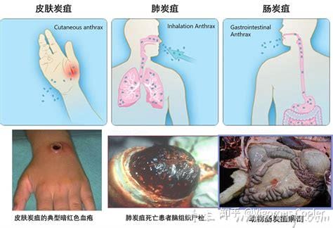 炭疽病图片人图片及症状,恶性脓疱在7天内坏死形成溃疡