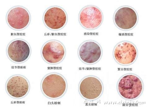 各种常见真菌皮肤病图片及症状对照大全,看图看自己(胆小慎点)