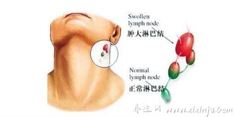 腋下淋巴癌早期症状图片,可移动的无痛小疙瘩伴随瘙痒很危险