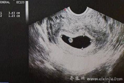 孕囊形状看男女(超准),看6-7周的3个数据(长条是男/圆形是女)