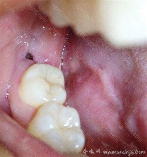 拔智齿后那个洞臭到恶心,拔牙后3-5天痛不欲生警惕干槽症