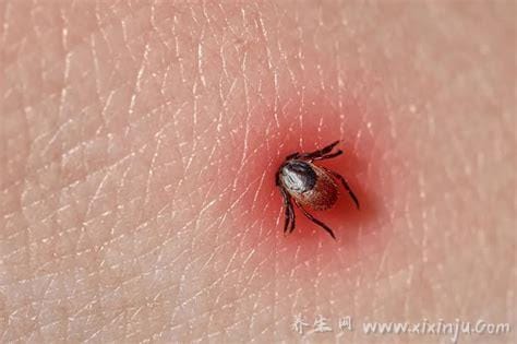 蜱虫咬人后的伤口图,出现红肿瘀斑或是黑痣样(严重会丧命)